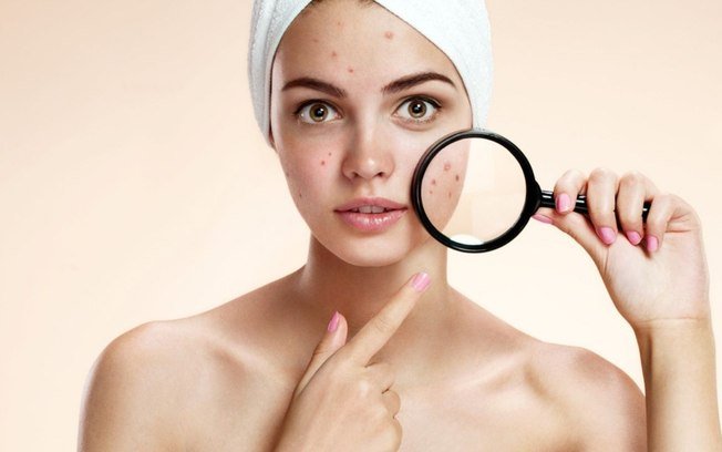 Mapa das espinhas: saiba o que significa a acne em cada área do rosto Mapa das espinhas: saiba o que significa a acne em cada área do rosto