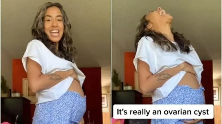Vídeo em que mulher mostra cisto gigante no ovário viraliza