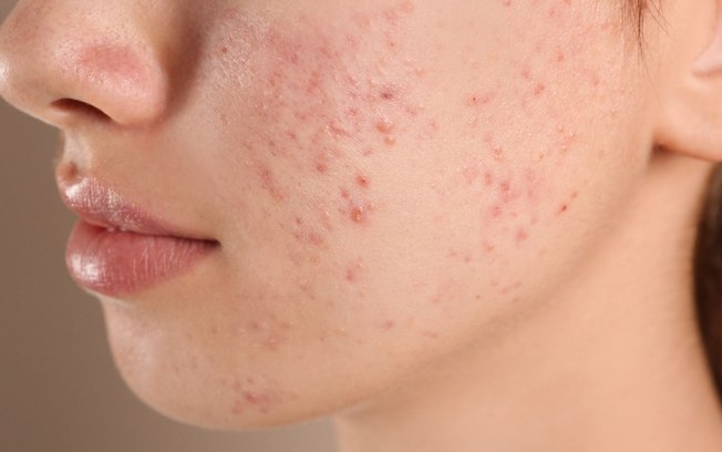Tudo o que você precisa saber sobre as cicatrizes de acne!