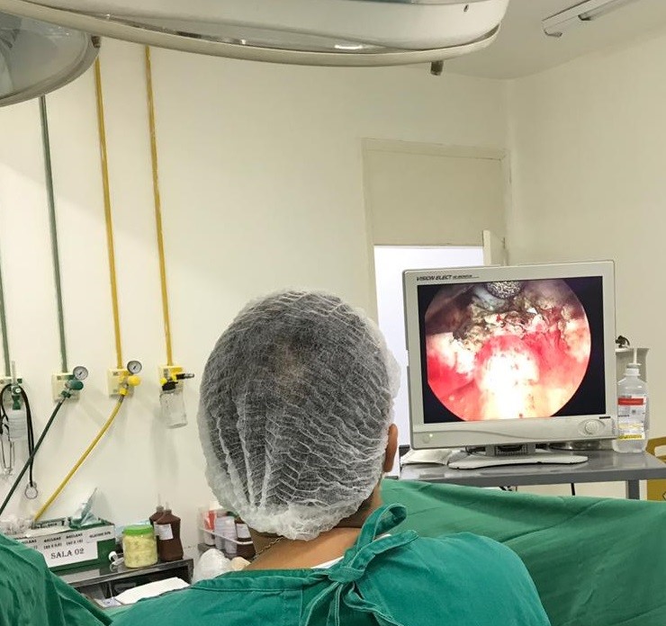 Mais Cirurgias do Governo do Estado avança com assistência urológica na Região do Leste Maranhense