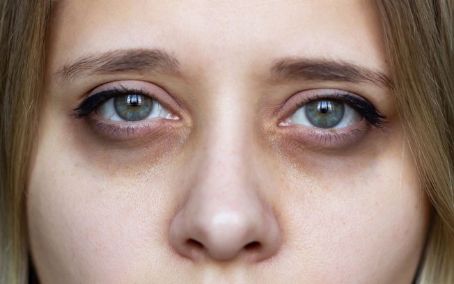 5 dicas para reduzir as olheiras de forma natural!