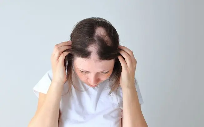 Queda de cabelo pode ser sinal de doença