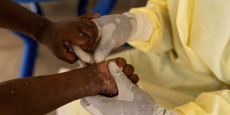 Vacina brasileira contra a mpox está próxima dos testes em humanos