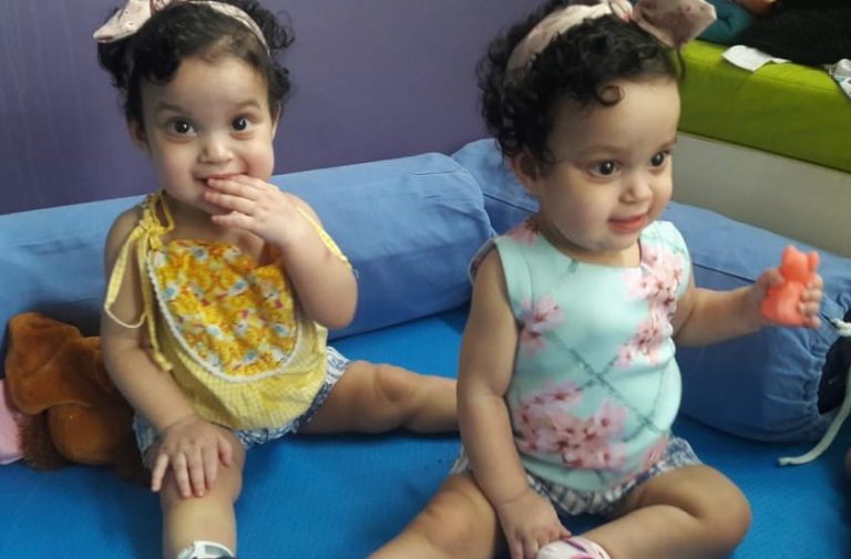 Cirurgia rara de separação de irmãs siamesas no Hospital Estadual da Criança completa um ano