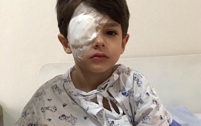 Após acidente, menino de 5 anos tem córnea queimada por álcool em gel