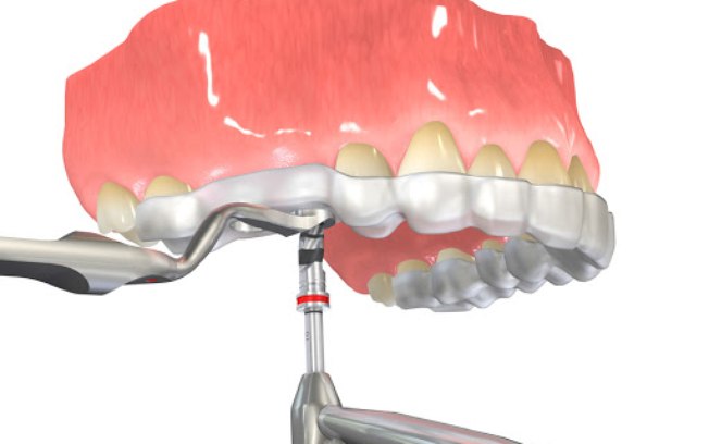 Implantes sem cortes? entende a cirurgia guiada na odontologia