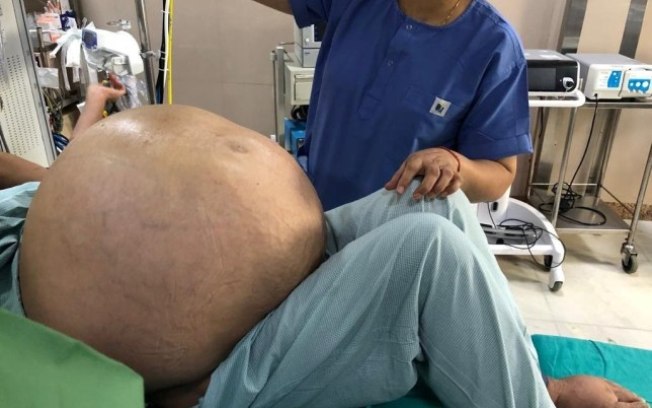 Tumor ovariano de 50 kg é removido de mulher em cirurgia; veja