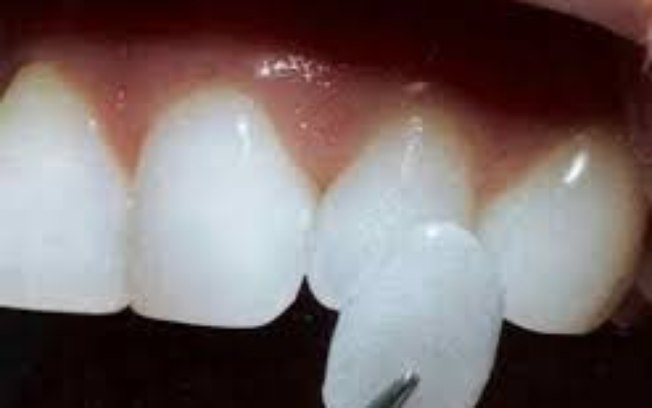 Odontologista tira as maiores dúvidas sobre lentes de contato dentais