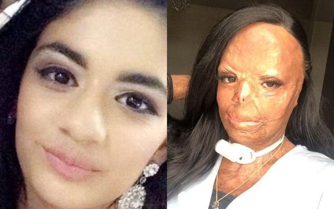 Adolescente sofre queimaduras no rosto após shampoo para piolhos pegar fogo